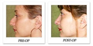 phoca_thumb_m_dr-begovic-rhinoplasty-before-after-003-side2