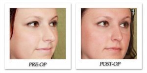 phoca_thumb_m_dr-begovic-rhinoplasty-before-after-004-oblique