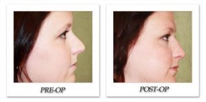 phoca_thumb_m_dr-begovic-rhinoplasty-before-after-004-side