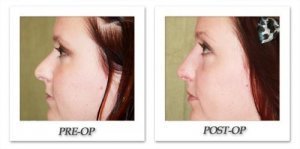 phoca_thumb_m_dr-begovic-rhinoplasty-before-after-004-side2