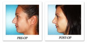 phoca_thumb_m_dr-begovic-rhinoplasty-before-after-005-1