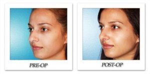 phoca_thumb_m_dr-begovic-rhinoplasty-before-after-005-2