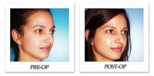 phoca_thumb_m_dr-begovic-rhinoplasty-before-after-005-4