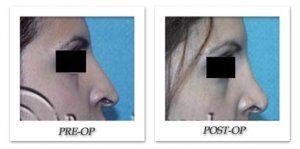 phoca_thumb_m_hodnett-rhinoplasty-001