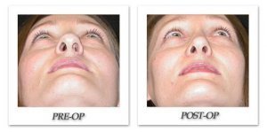 phoca_thumb_m_mandris-rhinoplasty-005