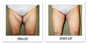 phoca_thumb_l_dr-begovic-thigh-lift-before-after-001