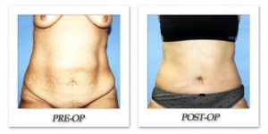 phoca_thumb_l_dr-begovic-tummy-tuck-before-after-002