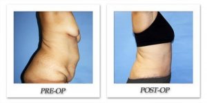 phoca_thumb_l_dr-begovic-tummy-tuck-before-after-003