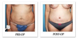 phoca_thumb_l_dr-begovic-tummy-tuck-before-after-006
