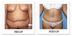 phoca_thumb_l_dr-begovic-tummy-tuck-before-after-007