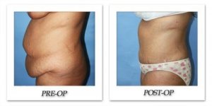 phoca_thumb_l_dr-begovic-tummy-tuck-before-after-008