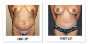 Tummy Tuck by Kincaid