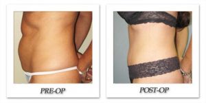 Tummy Tuck by Kincaid