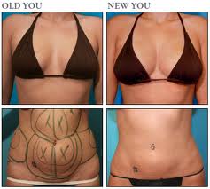 liposuction and transfer of fat to breast