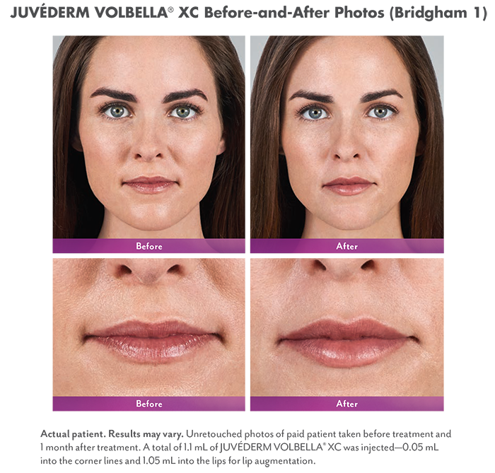 Juvederm Volbella