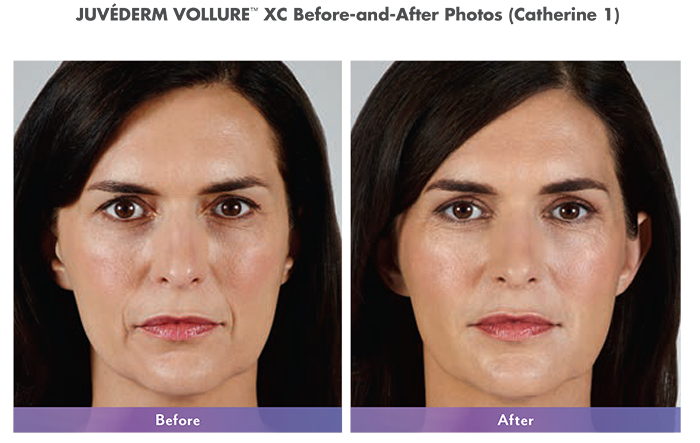 Juvederm Vollure