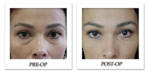blepharoplasty.jpg