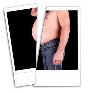 Tummy Tuck for Men