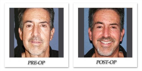 https://beverlyhillsphysicians.com/photogallery/photos/begovic/facelift/thumbs/phoca_thumb_l_dr-begovic-facelift-before-after-001-front.jpg