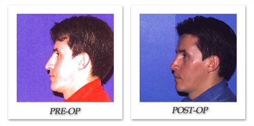 https://beverlyhillsphysicians.com/photogallery/photos/anous/rhinoplasty/thumbs/phoca_thumb_l_anous-rhinoplasty-014.jpg