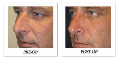 https://beverlyhillsphysicians.com/photogallery/photos/kincaid/rhinoplasty/image039.jpg