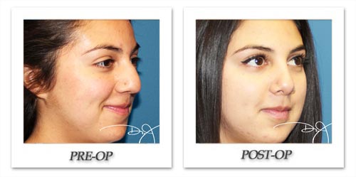 Rhinoplasty