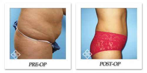 tummy-tuck-blog