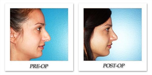rhinoplasty