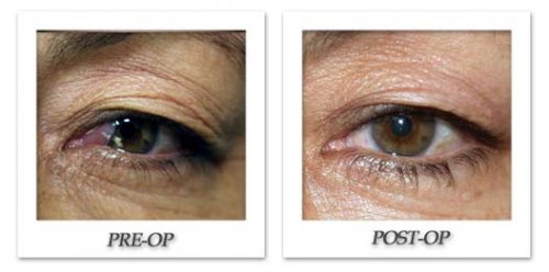 phoca thumb l israel-blepharoplasty-002