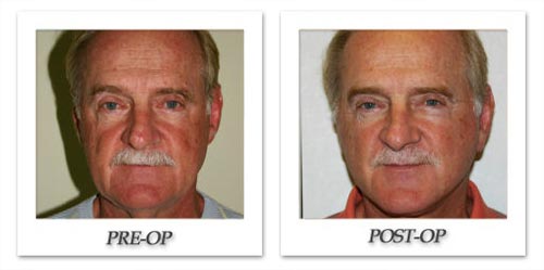 The Rising Trend of Male Chin Implants