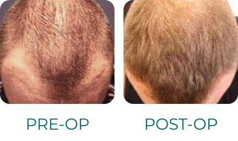 PRP Hair Restoration - Beverly Hills Physicians