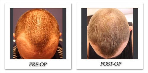 Hair Restoration for men and women
