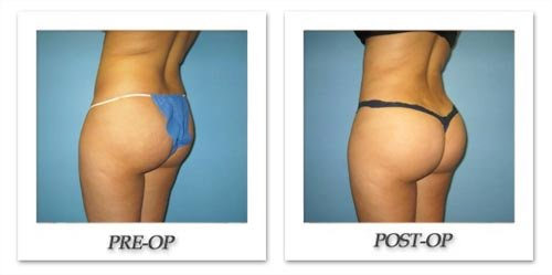 Latest Cosmetic Trends: Fat Transfer and Facial Rejuvenations