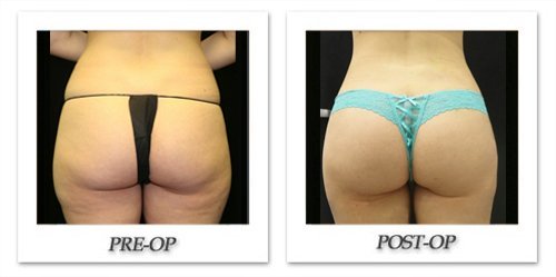 Brazilian Butt Lift Result