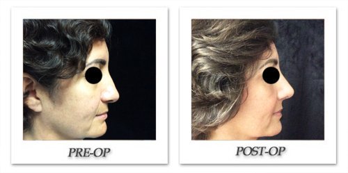 Ethnic Rhinoplasty Result