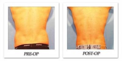 The Trend Toward More Male Plastic Surgery continues