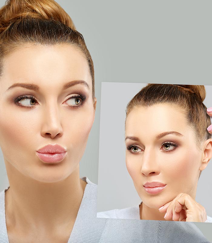 Rhinoplasty