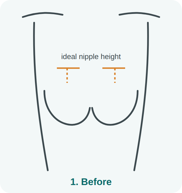 Breast lift step 1: before surgery, with the ideal nipple height marked