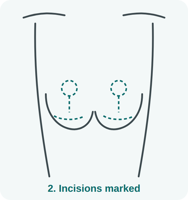 Breast lift step 2: incisions marked around the areola, down the center and along the breast crease