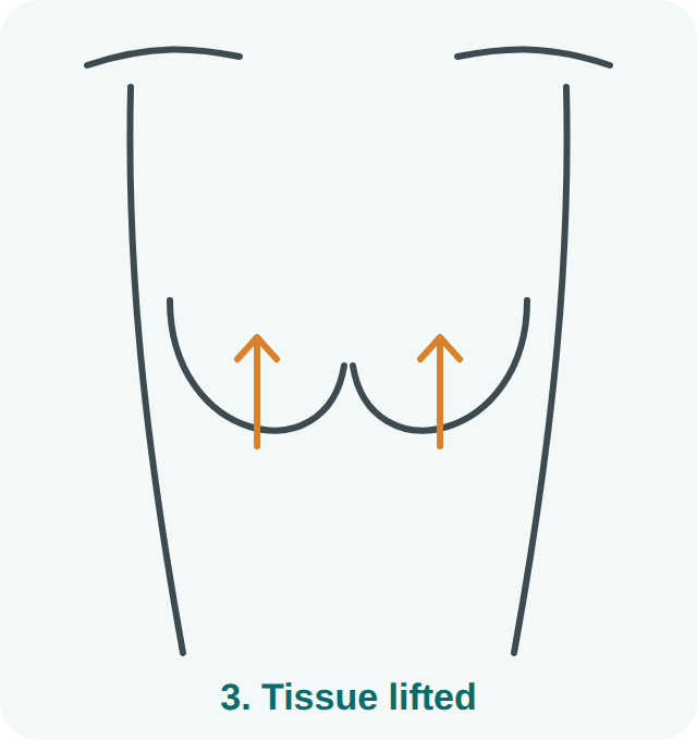 Breast lift step 3: breast tissue lifted to a higher position