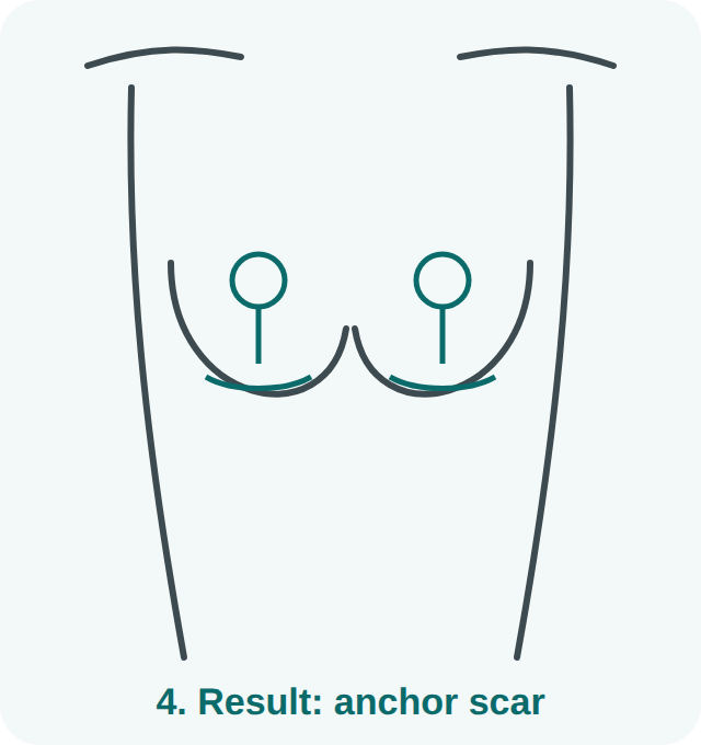 Breast lift step 4: result with the anchor-shaped scar