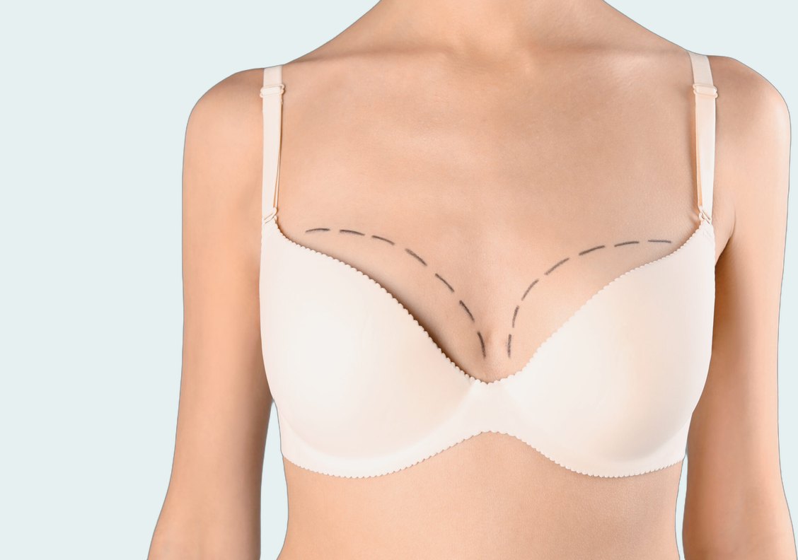 Breast Revision