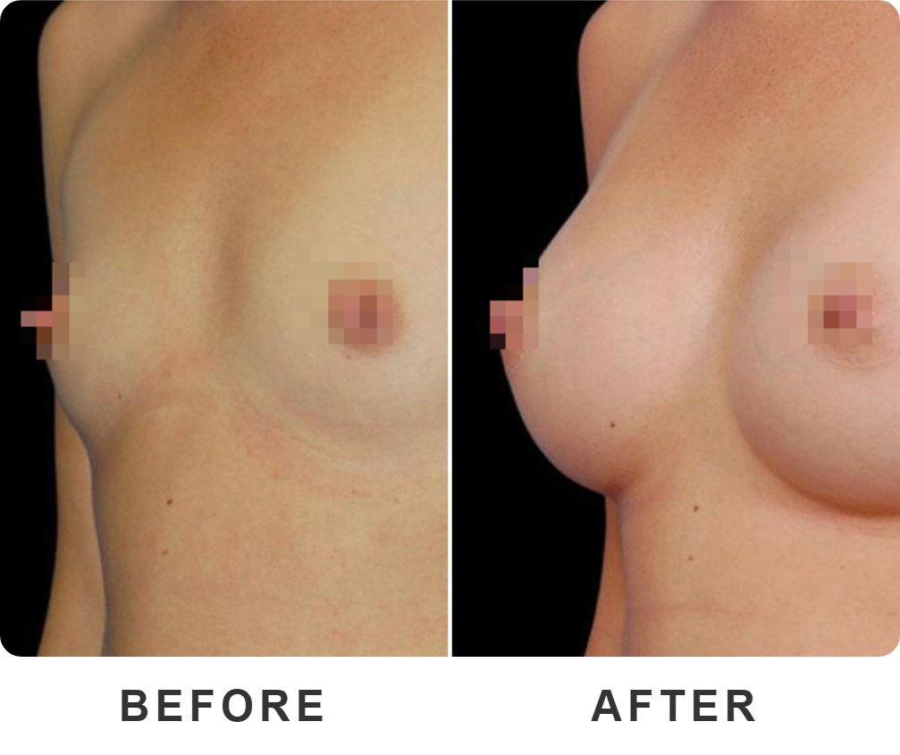 Breast augmentation before and after – Beverly Hills Physicians