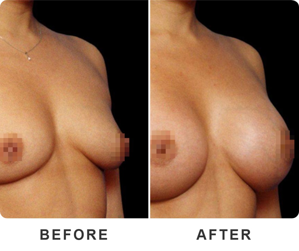 Breast augmentation before and after – Beverly Hills Physicians
