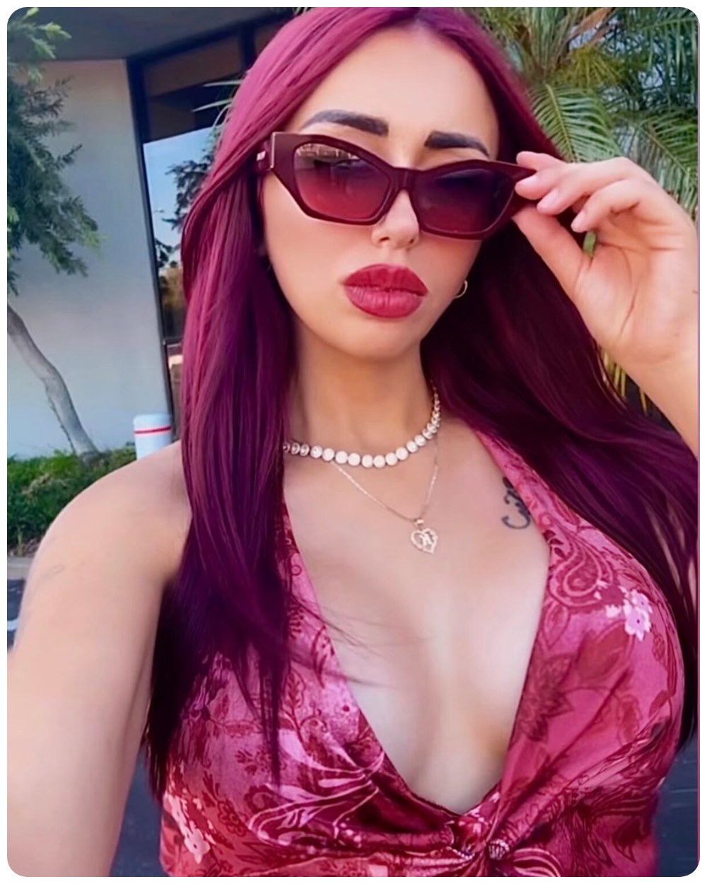 Breast augmentation results – Beverly Hills Physicians