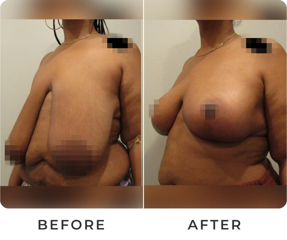 Breast reduction before and after – Beverly Hills Physicians