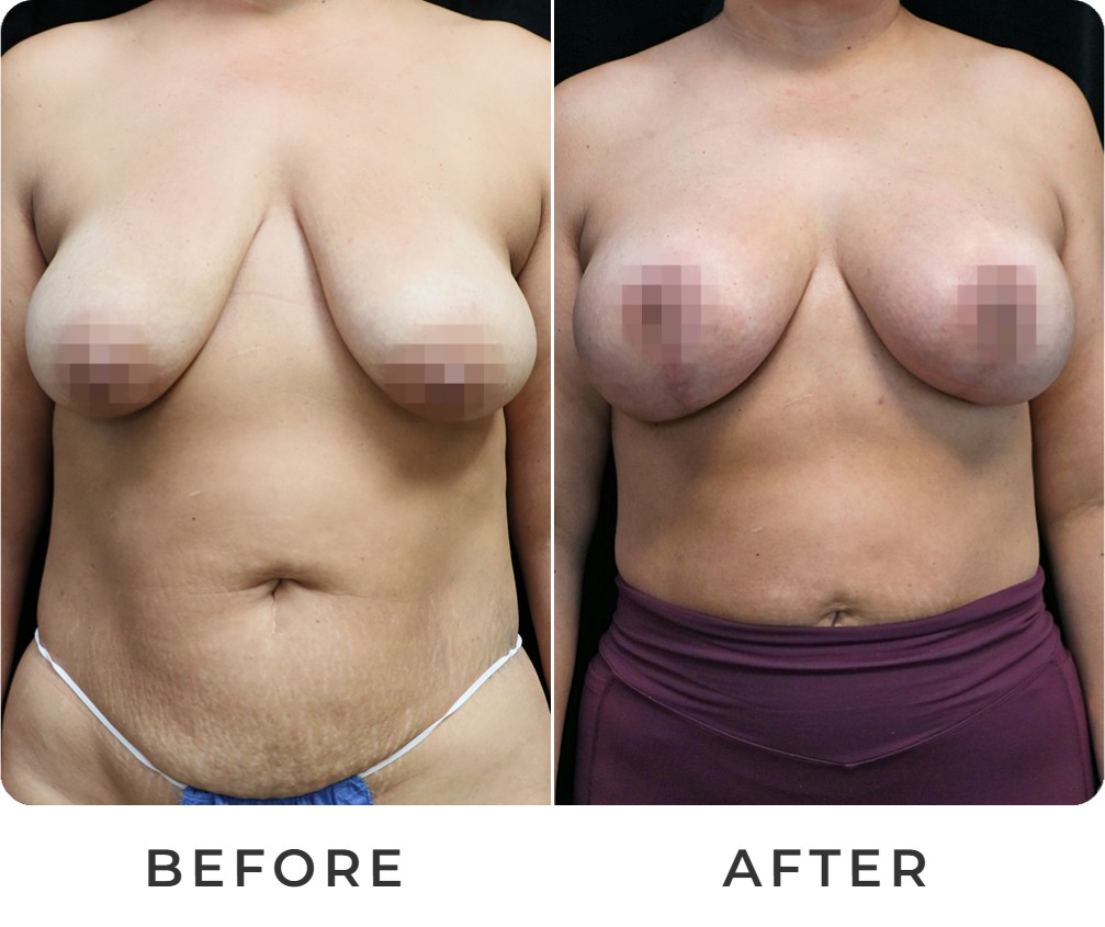 Breast reduction before and after – Beverly Hills Physicians