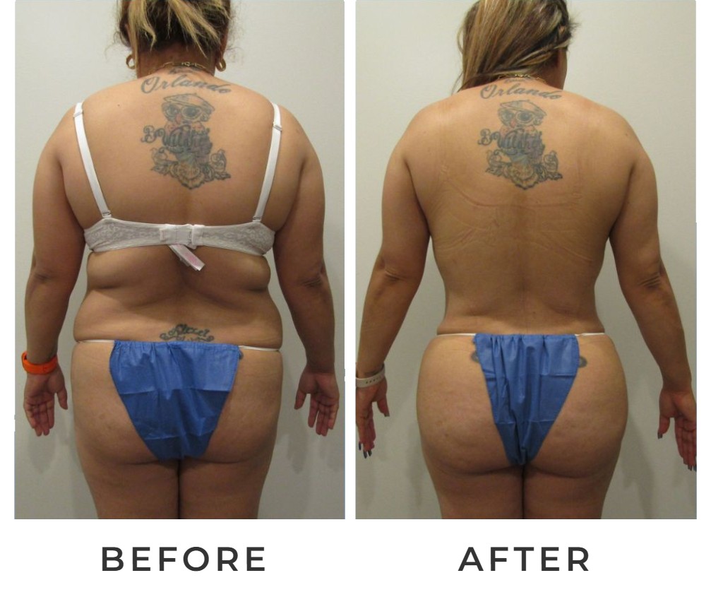 Lipo 360 before and after – Beverly Hills Physicians