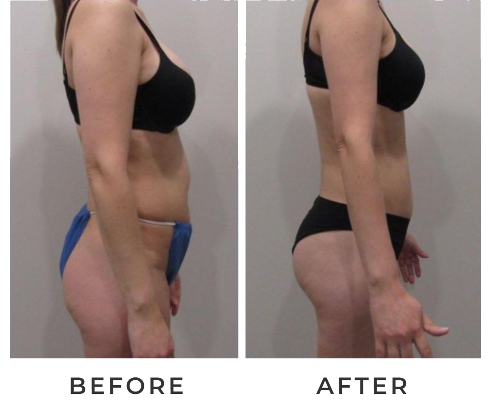 Liposuction with BBL before and after – Beverly Hills Physicians