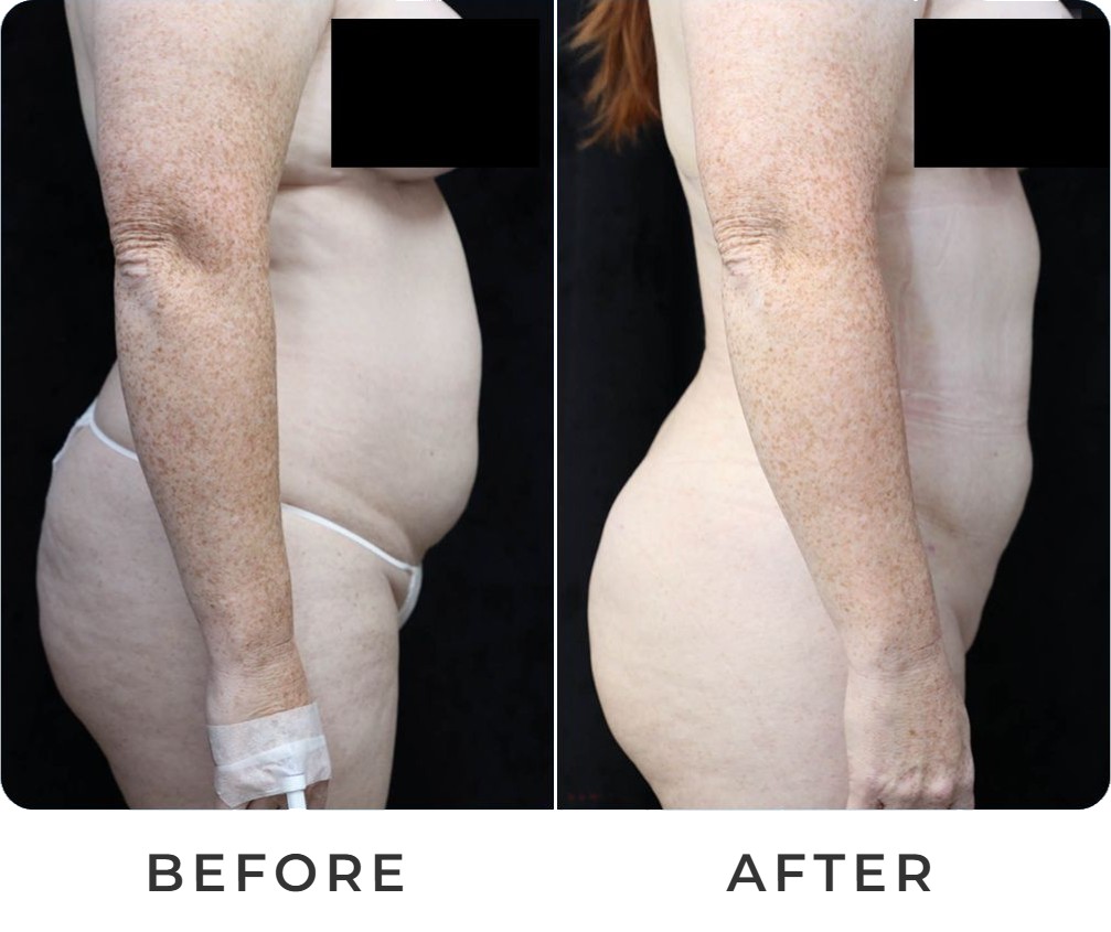 Liposuction with BBL before and after – Beverly Hills Physicians